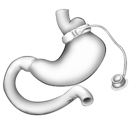Image illustrant la mise en place d'un anneau gastrique dans la chirurgie de l'obésité