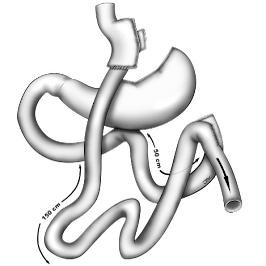 Image illustrant le bypass gastrique en Y dans la chirurgie de l'obésité