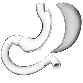 Image illustrant la sleeve gastrectomie dans la chirurgie de l'obésité